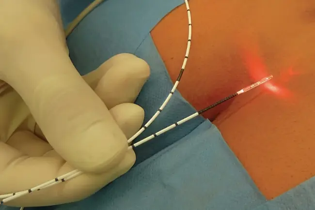 Fissure Dilatation