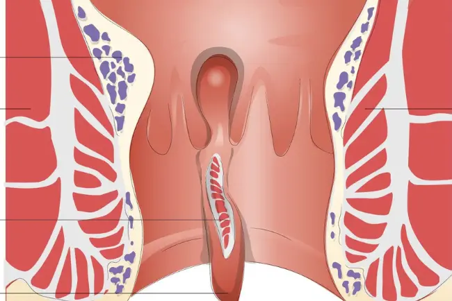 Fissurectomy