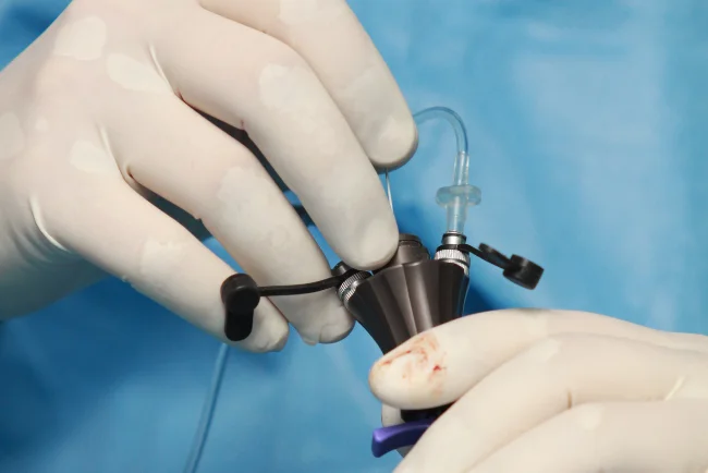 laparoscopic-surgery-indore.webp